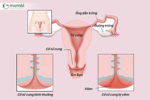 Viêm âm đạo do nấm, vi khuẩn khiến "cô bé" bị mùi 