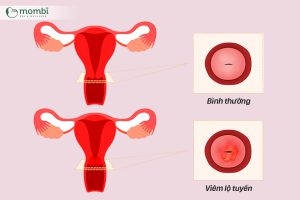 "Cô bé" mùi hôi tanh kèm theo bọt, ngứa rát. Dấu hiệu có thể bị viêm lộ tuyến tử cung