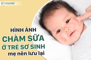 Ảnh trẻ sơ sinh bị chàm sữa, mẹ nên lưu lại!