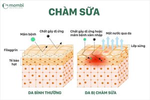 Tình trạng da bé khi bị chàm sữa